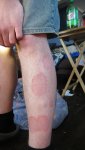 leg-rash.jpg