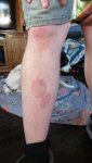 leg-rash2.jpg