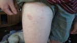 rash.jpg