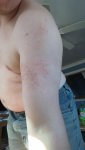 shoulder-rash.jpg