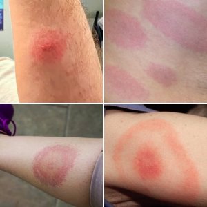 Lyme Rash Examples