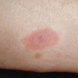 lyme-disease-fig-1-300x243.jpg