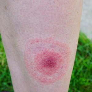 lyme-disease-rash.jpg