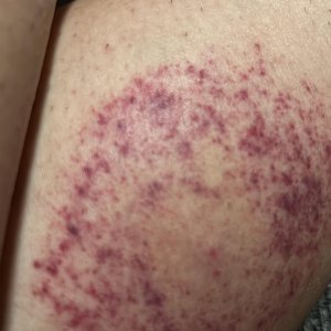 lyme-disease-v0-s6s8t7ralq5b1.jpg