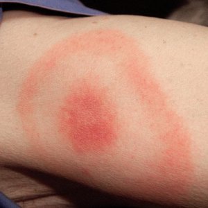 S_0817_lyme-disease_C0031417.max-600x600.jpg