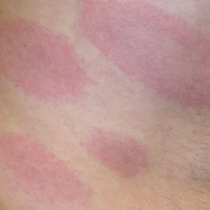 What-Does-Lyme-Disease-Look-Like.png