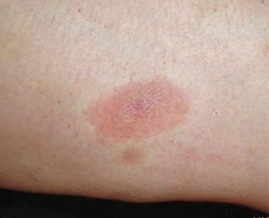 lyme-disease-fig-1-300x243.jpg