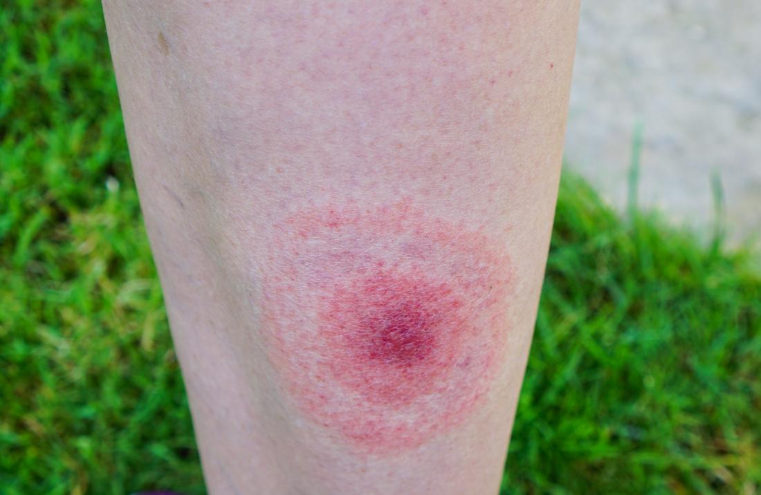 lyme-disease-rash.jpg