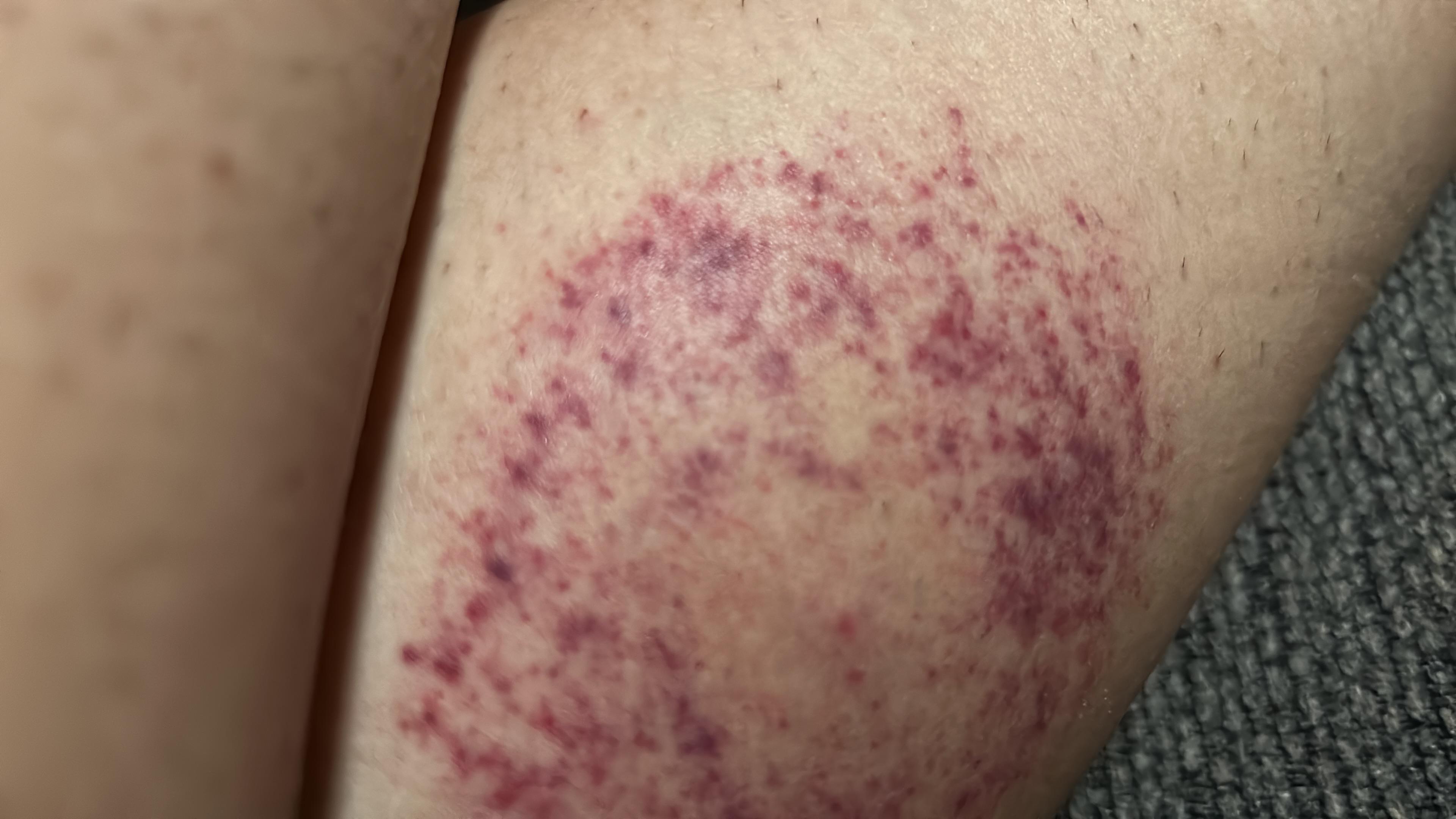 lyme-disease-v0-s6s8t7ralq5b1.jpg