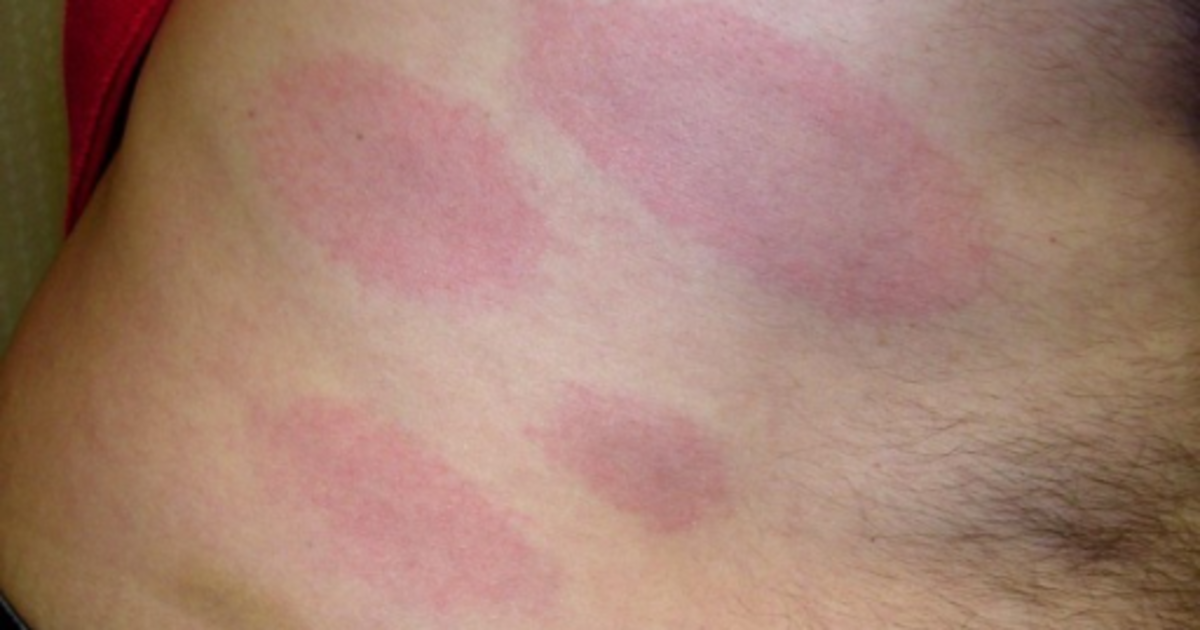 What-Does-Lyme-Disease-Look-Like.png