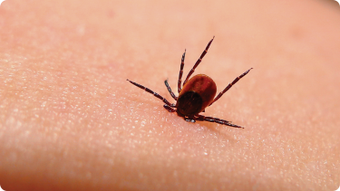 Tick embedded in the skin of a human