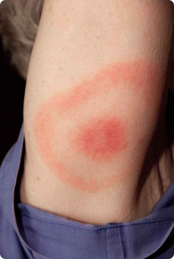 Notorious Bulls-eye Lyme Rash Typical Bulls-eye Rash