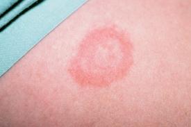 Erythema migrans rash photo